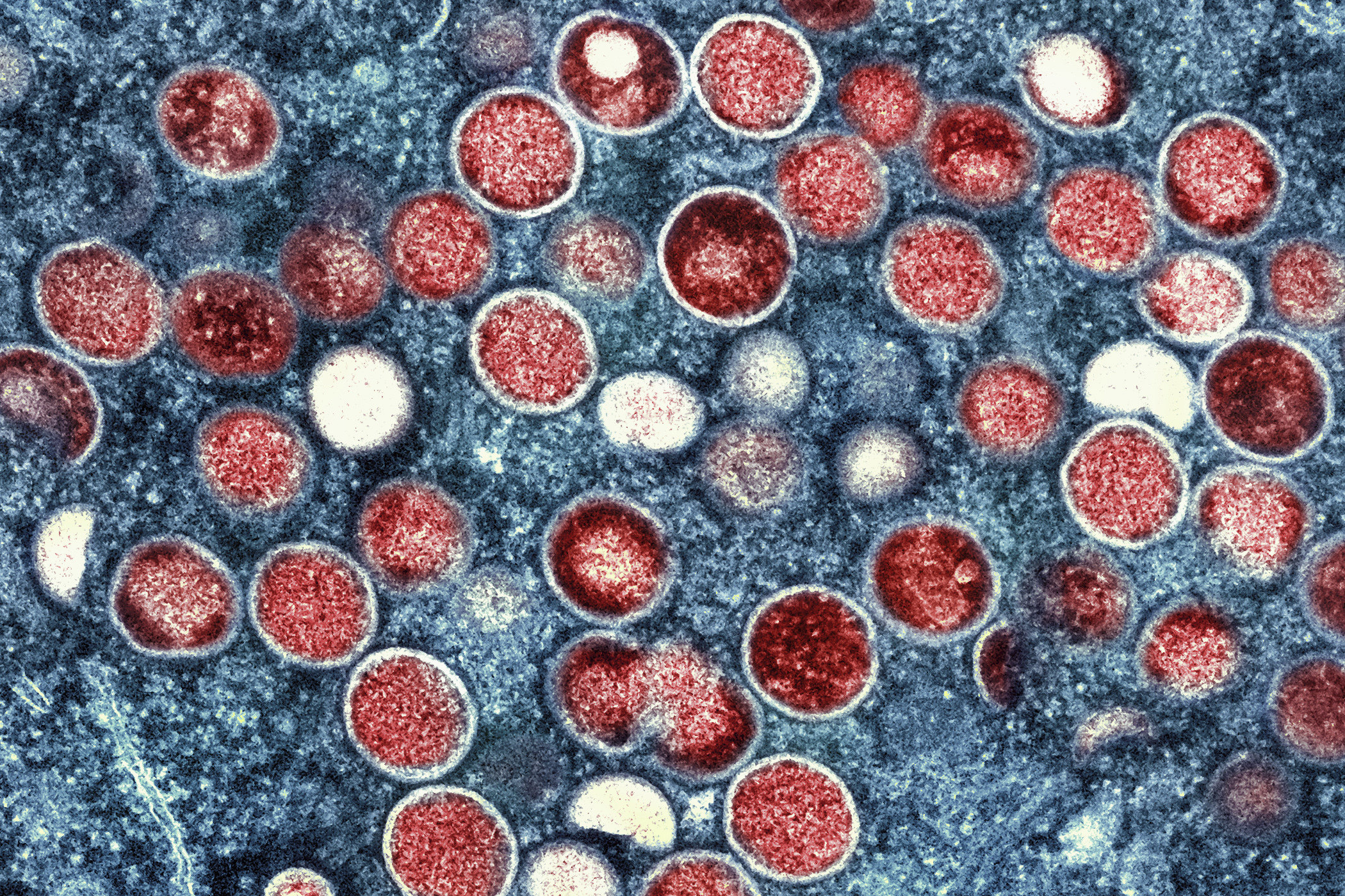 A colorised electron microscope image shows mpox particles in red found within an infected cell, shown as blue. Photo: AP